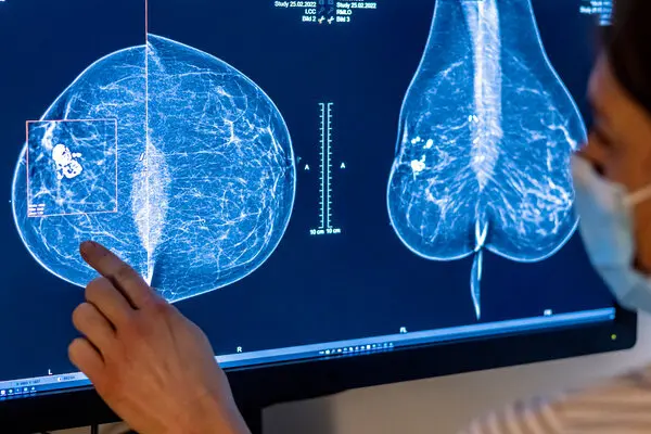 Breast cancer screenings allow clinicians to detect a cancer early, while it has less time to spread.